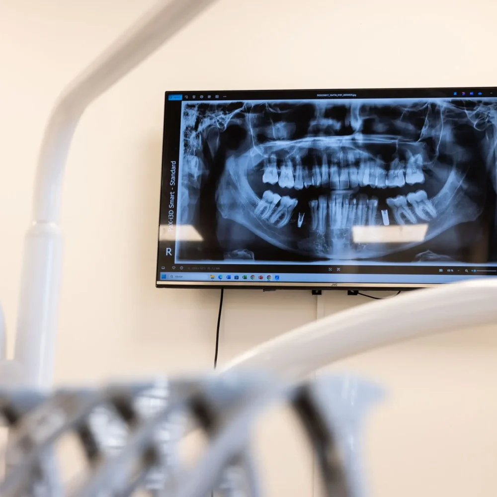 yes_dental_praha_rovnatka_implantaty_27_cc1b15e1ba